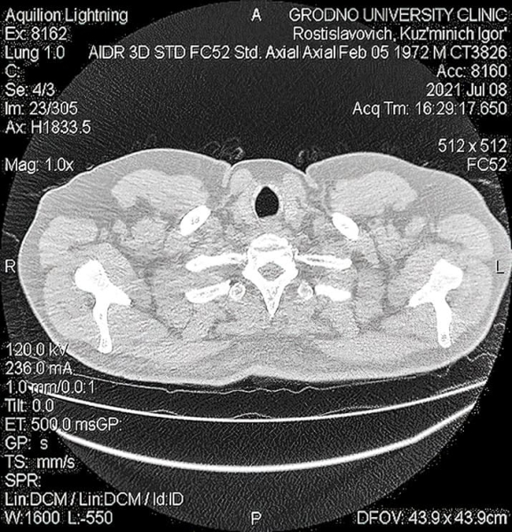COVID-ассоциированный инвазивный легочный аспергиллез: проблемы диагностики и лечения
COVID-ассоциированный инвазивный легочный аспергиллез: проблемы диагностики и лечения