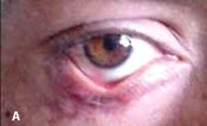 
        Лагофтальм: осложнения и лечение			
        
        