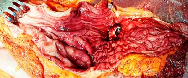 
        COVID-19-ассоциированные  изменения ЖКТ: данные ультразвуковых  и морфологических исследований			    