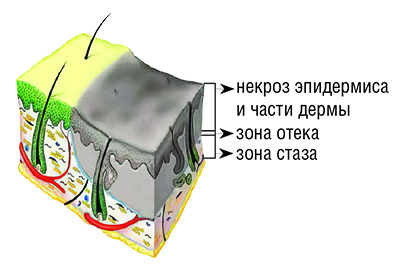 Ожоги: принципы диагностики и выбор тактики лечения. Часть 1
Ожоги: принципы диагностики и выбор тактики лечения. Часть 1