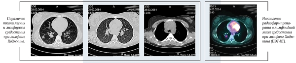 Лимфома Ходжкина у детей и подростков
Лимфома Ходжкина у детей и подростков