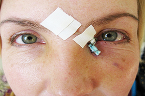 Лечение слезотечения. Часть 2
Лечение слезотечения. Часть 2