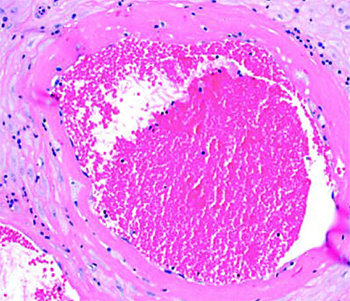 Патология плаценты при COVID-19			     
        Патология плаценты при COVID-19