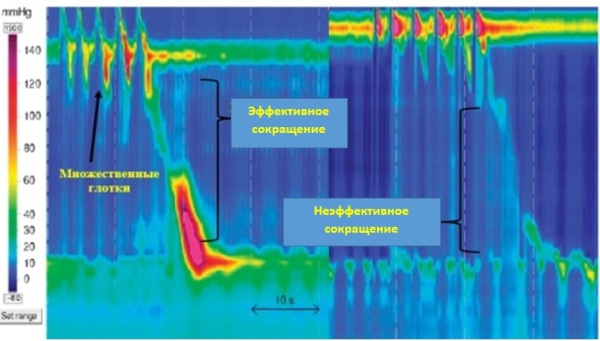 Манометрия пищевода высокого разрешения			     
        Манометрия пищевода высокого разрешения