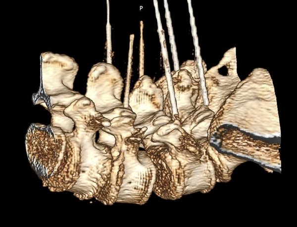 Фасеточный синдром: радиочастотная денервация фасеточных суставов			     
        Фасеточный синдром: радиочастотная денервация фасеточных суставов