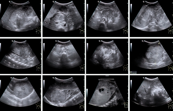 Нейробластома у детей: пути снижения запущенных случаев
Нейробластома у детей: пути снижения запущенных случаев