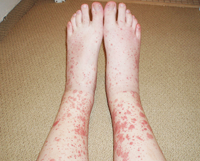 
        Дерматологические осложнения COVID-19 и тактика ведения пациентов с заболеваниями кожи			    