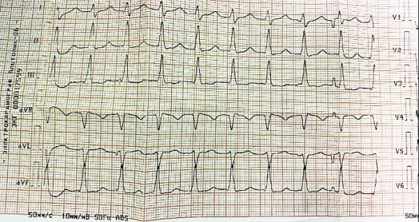 
        АВУРТ и АВРТ: лекарственная терапия или катетерная аблация?			    