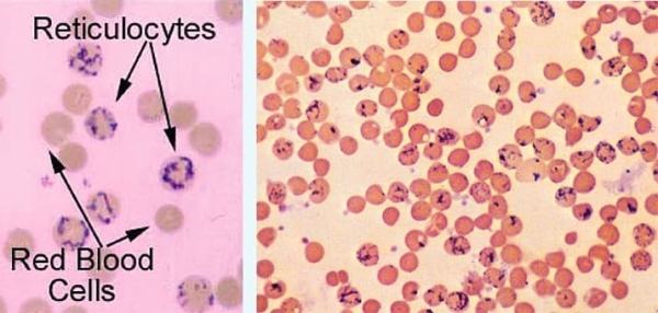 
        Гемолитические анемии у детей: клиника и алгоритм диагностики			    