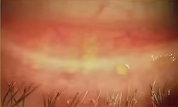 Инфицирование клещом  рода Demodex: хронический блефарит, дисфункция мейбомиевых желез и сухой глаз 			     
        Инфицирование клещом  рода Demodex: хронический блефарит, дисфункция мейбомиевых желез и сухой глаз