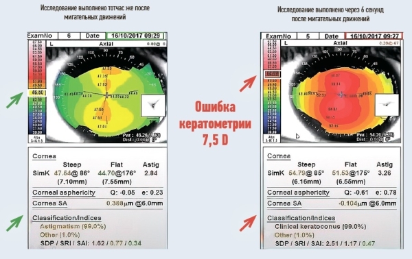 
        Инфицирование клещом  рода Demodex: хронический блефарит, дисфункция мейбомиевых желез и сухой глаз 			    
