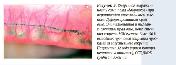 
        Инфицирование клещом  рода Demodex: хронический блефарит, дисфункция мейбомиевых желез и сухой глаз 			    