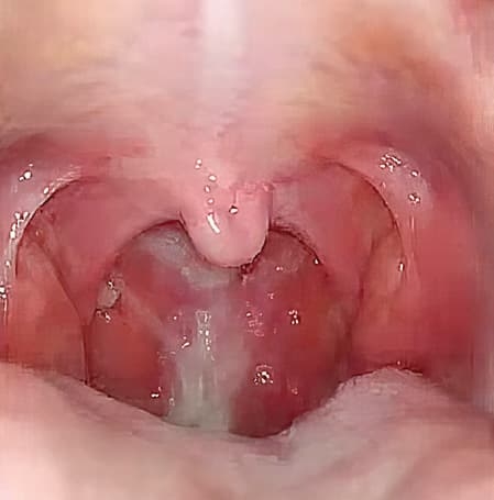 
        Ребенок с лор-патологией на приеме у ВОП и педиатра			    