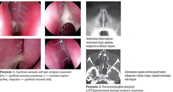 
        Ребенок с лор-патологией на приеме у ВОП и педиатра			    