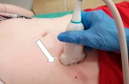 
        Алгоритм ультразвуковой диагностики острого аппендицита			    
