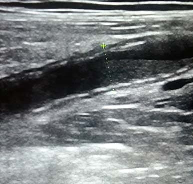Алгоритм ультразвуковой диагностики острого аппендицита			     
        Алгоритм ультразвуковой диагностики острого аппендицита