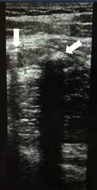 Алгоритм ультразвуковой диагностики острого аппендицита			     
        Алгоритм ультразвуковой диагностики острого аппендицита