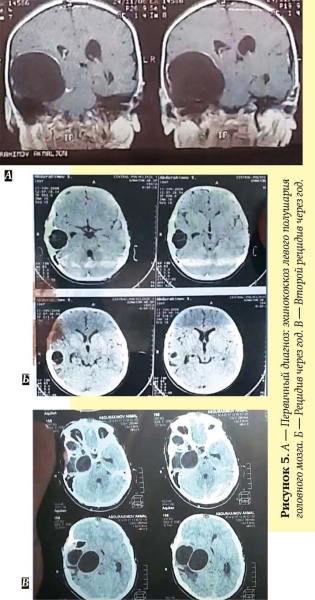 Эхинококкоз: как избежать послеоперационных рецидивов			     
        Эхинококкоз: как избежать послеоперационных рецидивов