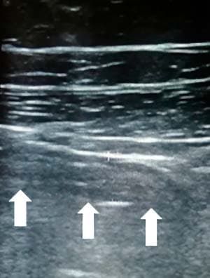 Алгоритм ультразвуковой диагностики острого аппендицита			     
        Алгоритм ультразвуковой диагностики острого аппендицита