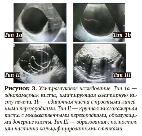 Эхинококкоз: как избежать послеоперационных рецидивов			     
        Эхинококкоз: как избежать послеоперационных рецидивов