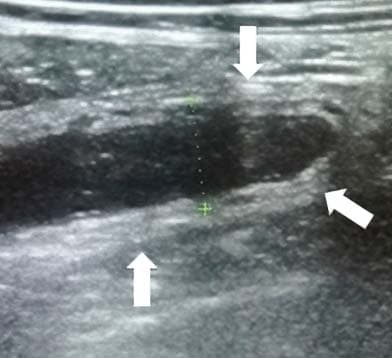 Алгоритм ультразвуковой диагностики острого аппендицита			     
        Алгоритм ультразвуковой диагностики острого аппендицита