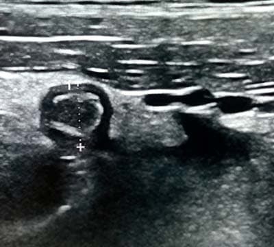 Алгоритм ультразвуковой диагностики острого аппендицита			     
        Алгоритм ультразвуковой диагностики острого аппендицита