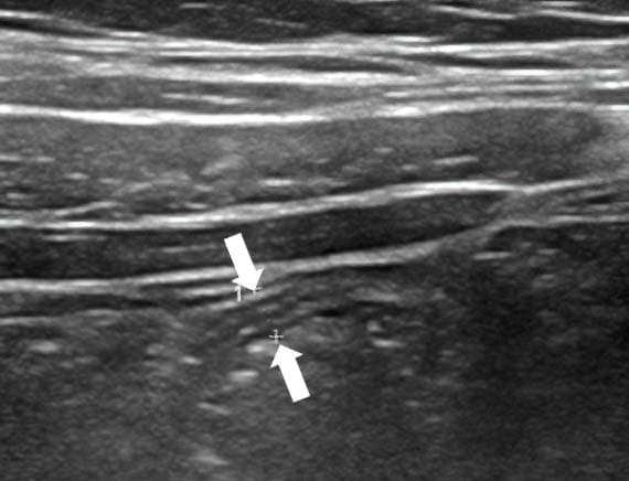 Алгоритм ультразвуковой диагностики острого аппендицита			     
        Алгоритм ультразвуковой диагностики острого аппендицита