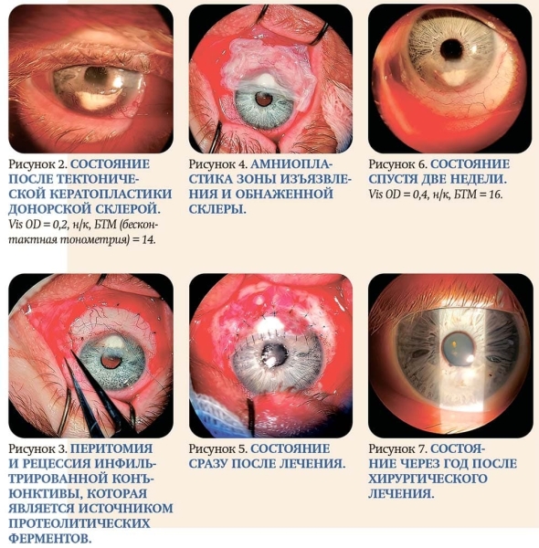 
        Хирургическое лечение периферических язв роговицы			    