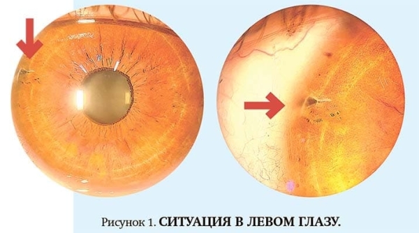 
        Внутриглазная миграция металлического инородного тела			    