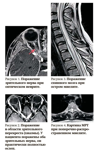 
        Заболевания спектра оптиконейромиелита                    
