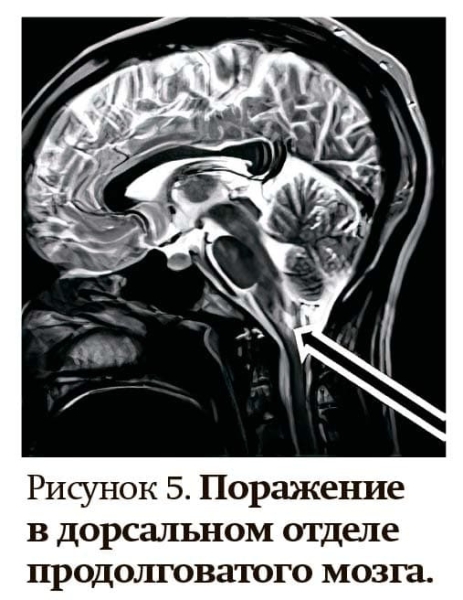 Заболевания спектра оптиконейромиелита                     
        Заболевания спектра оптиконейромиелита