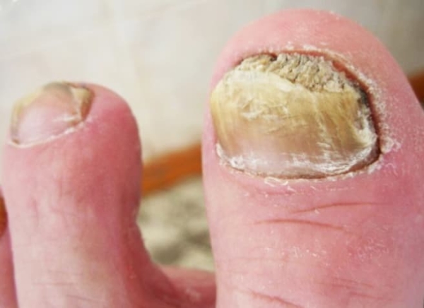 
        Ногти: клинико-диагностическая значимость в практике дерматолога + аудио                
        
        