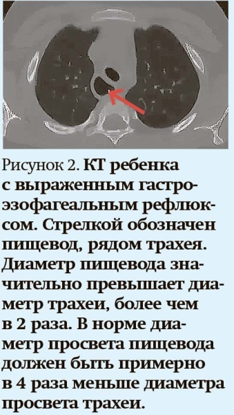 
        Кашель у детей: особенности дифференциальной диагностики                    
