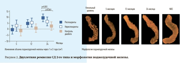 
        Ремиссия сахарного диабета 2-го типа: миф или реальность?                    