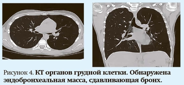 
        Кашель у детей: особенности дифференциальной диагностики                    