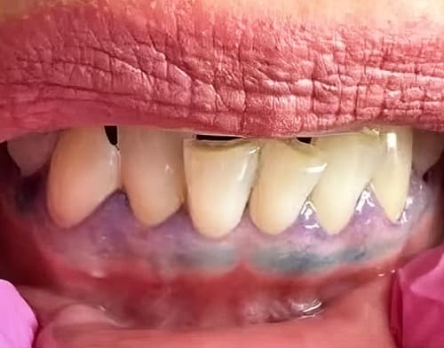 
        ГЭРБ снимает &laquo;маску&raquo;: стоматологические проявления, под которыми прячется заболевание + аудио                
        
        