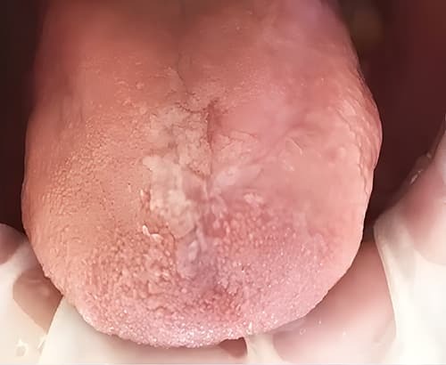 
        ГЭРБ снимает &laquo;маску&raquo;: стоматологические проявления, под которыми прячется заболевание + аудио                
        
        