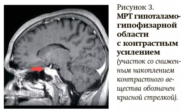 Как не пропустить болезнь Кушинга у детей?                     
        Как не пропустить болезнь Кушинга у детей?
