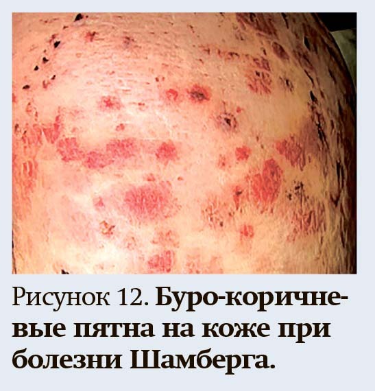 
        Геморрагический синдром: клиническая оценка и тесты                    