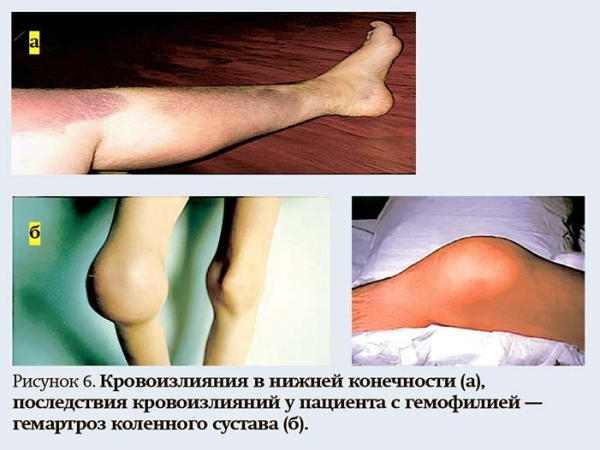 
        Геморрагический синдром: клиническая оценка и тесты                    