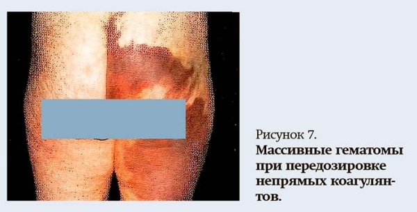 Геморрагический синдром: клиническая оценка и тесты                     
        Геморрагический синдром: клиническая оценка и тесты