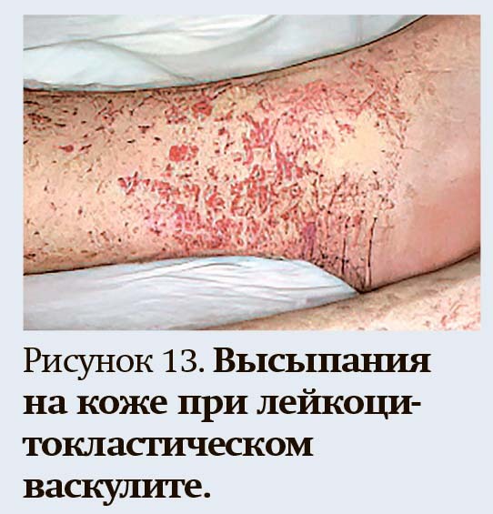 Геморрагический синдром: клиническая оценка и тесты                     
        Геморрагический синдром: клиническая оценка и тесты