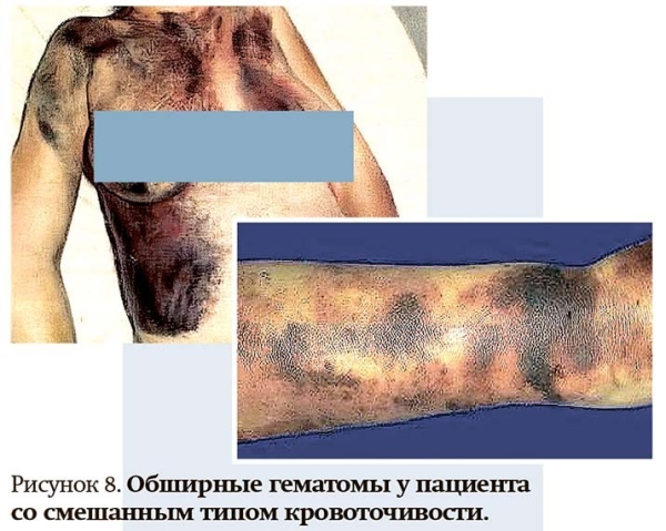 
        Геморрагический синдром: клиническая оценка и тесты                    
