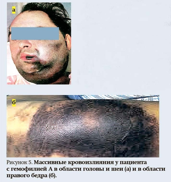 Геморрагический синдром: клиническая оценка и тесты                     
        Геморрагический синдром: клиническая оценка и тесты