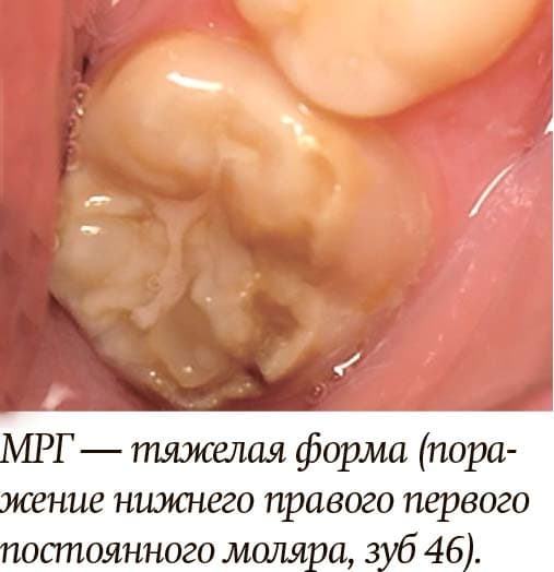 Диагностика и лечение молярно-резцовой гипоминерализации у детей + аудио
Диагностика и лечение молярно-резцовой гипоминерализации у детей + аудио