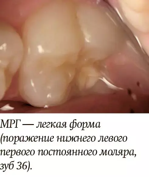 
        Диагностика и лечение молярно-резцовой гипоминерализации у детей + аудио                
        
        