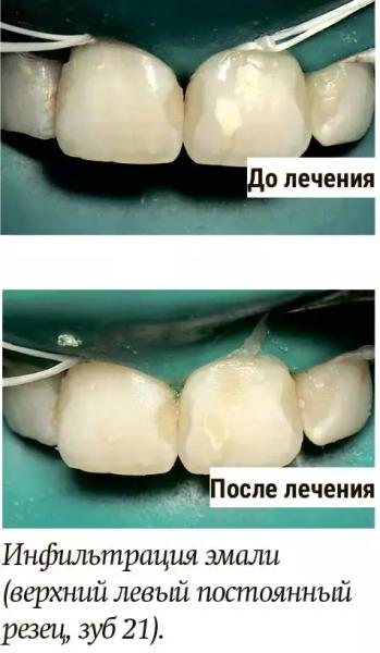 
        Диагностика и лечение молярно-резцовой гипоминерализации у детей + аудио                
        
        