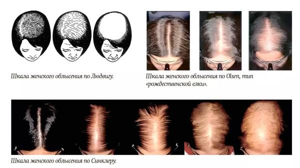 
        Алопеция у женщин: поиск возможных причин  и подходы к лечению                     