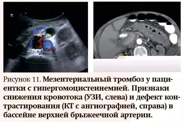 Лучевая диагностика при кровотечениях и тромбозах: плюсы и минусы разных методов                     
        Лучевая диагностика при кровотечениях и тромбозах: плюсы и минусы разных методов