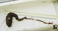 Халитоз: от симптома к диагнозу и терапии
Халитоз: от симптома к диагнозу и терапии